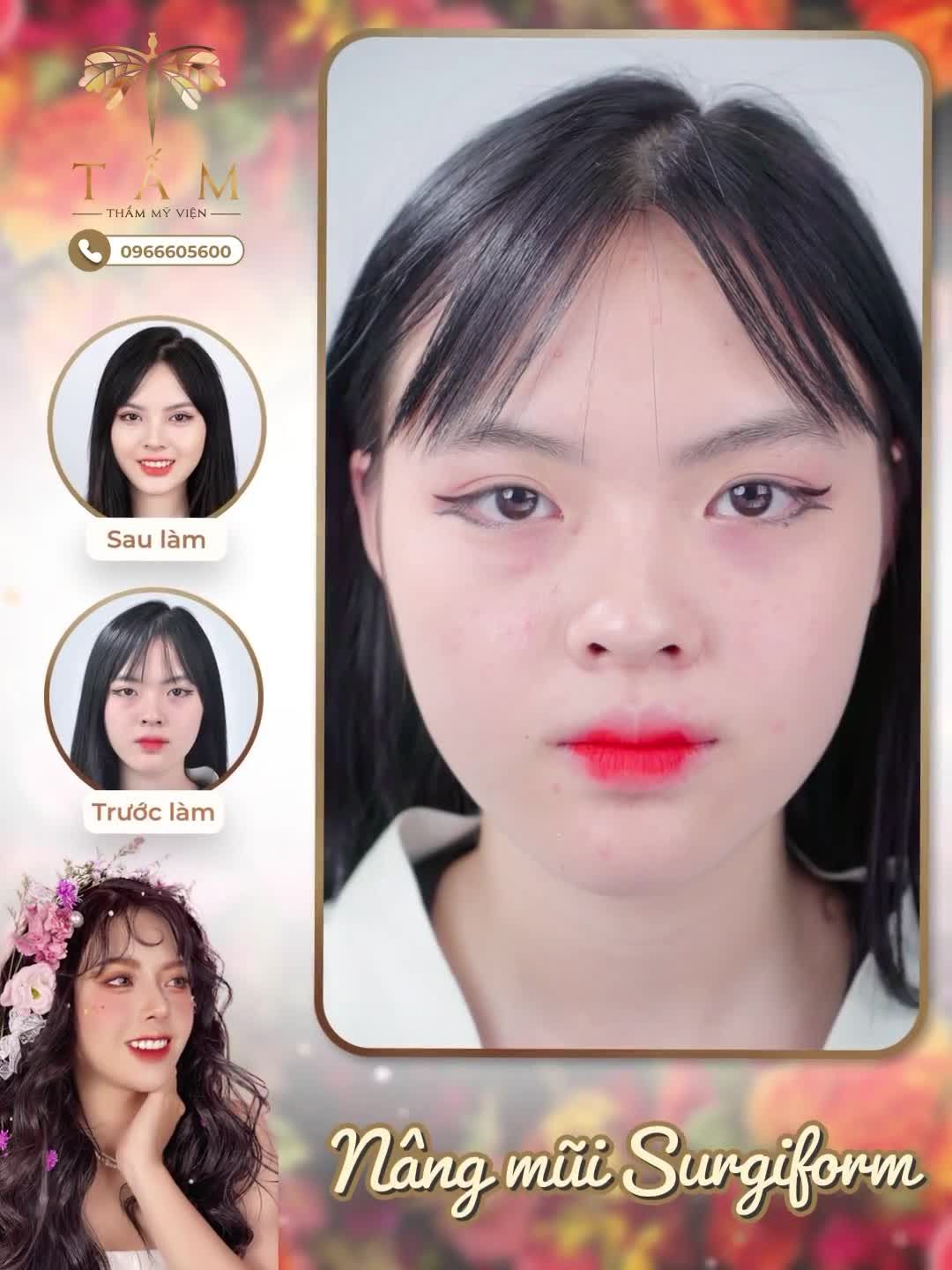 Biến hoá gương mặt đẹp tựa hot girl nhờ nâng mũi Surgiform tại TMV Tấm